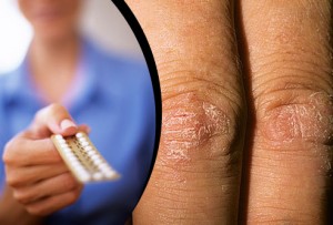 Atención a los enfermos de psoriasis.