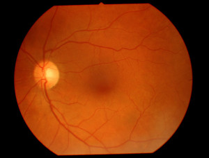 Imagen de degeneración macular.