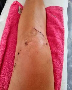 Imagen de la rodilla operada de Carolina Marín que acompaña a la carta a sus seguidores. / Foto: @CarolinaMarin.